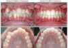 Expertise Matters When It Comes to Your Invisalign Adult Treatment Invisalign
