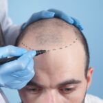 hair transplant cost in Ludhiana